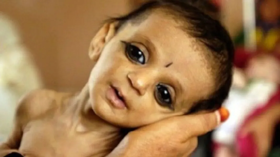 Child malnutrition in India